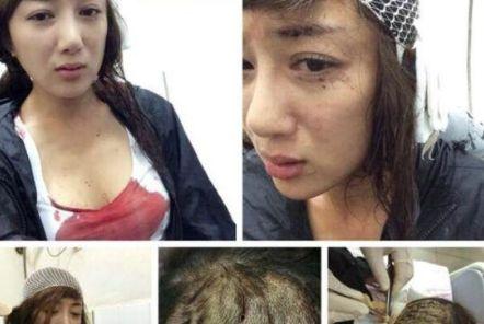 郑州整形失败爆料案件视频